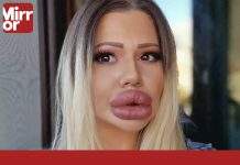 Woman with ‘world’s biggest lips’ is in severe pain – but docs won’t touch her