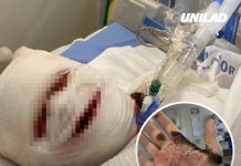 How woman’s face ‘fell off’ following rare reaction to Ibuprofen that left her in a coma