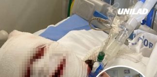 How woman’s face ‘fell off’ following rare reaction to Ibuprofen that left her in a coma