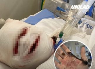 How woman’s face ‘fell off’ following rare reaction to Ibuprofen that left her in a coma