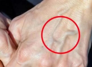 When to Worry About Veins That Appear Out of Nowhere