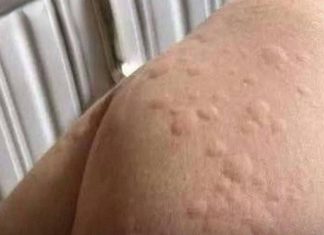 WHAT’S REALLY CAUSING YOUR HIVES? UNEXPECTED TRIGGERS