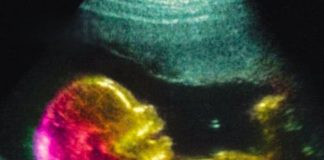 NEW STUDY UNCOVERS CRUCIAL CLUE IN UNDERSTANDING AUTISM’S ROOT CAUSES