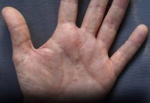 PAINFUL RED BUMPS ON YOUR HANDS OR FEET? IT COULD BE DYSHIDROTIC ECZEMA