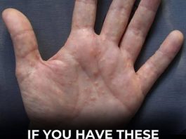 PAINFUL RED BUMPS ON YOUR HANDS OR FEET? IT COULD BE DYSHIDROTIC ECZEMA