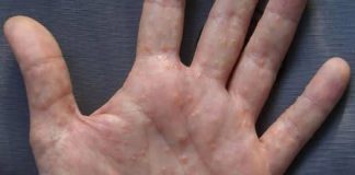 PAINFUL RED BUMPS ON YOUR HANDS OR FEET? IT COULD BE DYSHIDROTIC ECZEMA