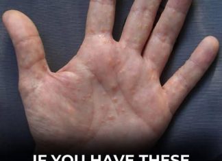 PAINFUL RED BUMPS ON YOUR HANDS OR FEET? IT COULD BE DYSHIDROTIC ECZEMA