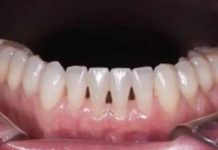 THE DENTIST EXPLAINS WHAT IT MEANS TO HAVE BLACK TRIANGLES BETWEEN YOUR TEETH.