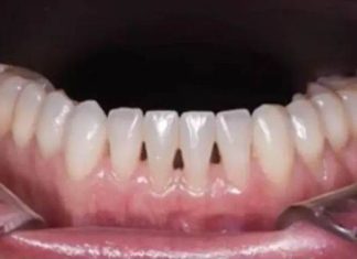 THE DENTIST EXPLAINS WHAT IT MEANS TO HAVE BLACK TRIANGLES BETWEEN YOUR TEETH.