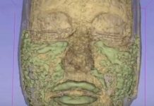 A 33-YEAR-OLD WOMAN’S MRI SCAN SHOWS WHERE ALL OF HER FILLER WENT, ACCORDING TO HER DOCTOR.