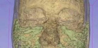 A 33-YEAR-OLD WOMAN’S MRI SCAN SHOWS WHERE ALL OF HER FILLER WENT, ACCORDING TO HER DOCTOR.