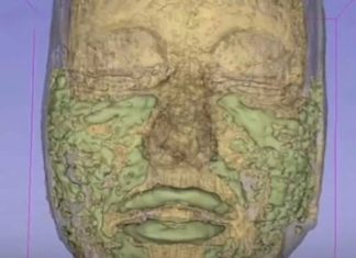 A 33-YEAR-OLD WOMAN’S MRI SCAN SHOWS WHERE ALL OF HER FILLER WENT, ACCORDING TO HER DOCTOR.