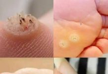 6 Types of Warts (Signs, Symptoms, Home Remedies, and Treatment)