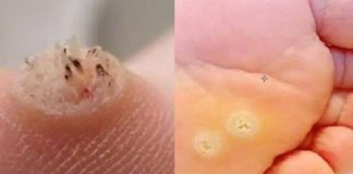 6 Types of Warts (Signs, Symptoms, Home Remedies, and Treatment)