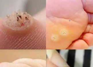 6 Types of Warts (Signs, Symptoms, Home Remedies, and Treatment)