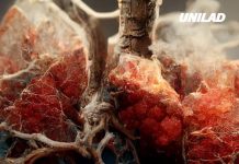 Symptoms of lung cancer explained as doctors admit disease isn’t ‘just for smokers’