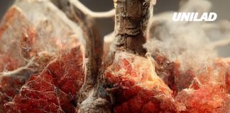 Symptoms of lung cancer explained as doctors admit disease isn’t ‘just for smokers’