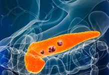 6 WARNING SIGNS OF PANCREATIC CANCER YOU SHOULDN’T OVERLOOK