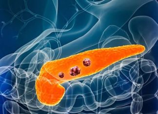 6 WARNING SIGNS OF PANCREATIC CANCER YOU SHOULDN’T OVERLOOK