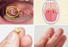 Here’s What You Need to Know About Tonsil Stones