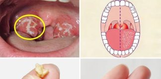 Here’s What You Need to Know About Tonsil Stones