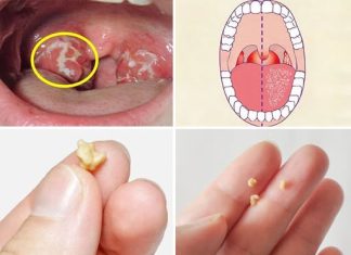 Here’s What You Need to Know About Tonsil Stones