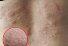 18 Signs of Histamine Intolerance (and what causes it)