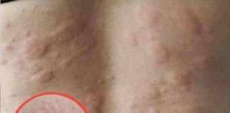 18 Signs of Histamine Intolerance (and what causes it)