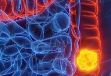 Woman reveals five colon cancer symptoms that should not be ignored