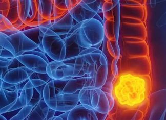 Woman reveals five colon cancer symptoms that should not be ignored