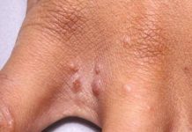 11 Reasons Why You Have Red Dots On Your Skin