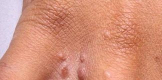 11 Reasons Why You Have Red Dots On Your Skin