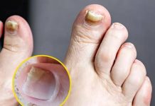 Health Expert Reveals Warning Signs of Two Silent Foot Killers and How To Spot Them