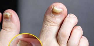Health Expert Reveals Warning Signs of Two Silent Foot Killers and How To Spot Them