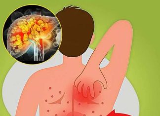 THE COMPLETE GUIDE TO FATTY LIVER: CAUSES, SYMPTOMS, TREATMENT, AND EFFECTIVE HOME REMEDIES