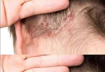 THE MYSTERY MARK: WHAT THOSE COMMON BUMPS AND SPOTS ON MY CHILD’S HEAD REALLY ARE