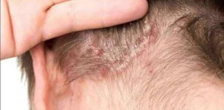 THE MYSTERY MARK: WHAT THOSE COMMON BUMPS AND SPOTS ON MY CHILD’S HEAD REALLY ARE