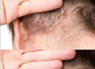 THE MYSTERY MARK: WHAT THOSE COMMON BUMPS AND SPOTS ON MY CHILD’S HEAD REALLY ARE