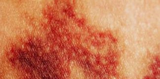 Why So Many Women Wake Up With Bruises They Don’t Remember Getting