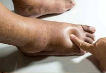 10 Swollen Feet Causes + When To See Your Doctor