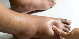10 Swollen Feet Causes + When To See Your Doctor