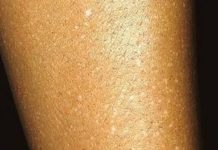 Have You Noticed Small White Spots on Your Arms or Legs and Don’t Know What They Are? Here’s What Experts Think