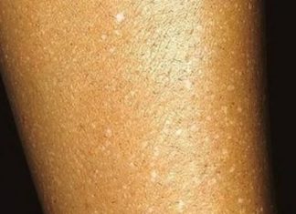 Have You Noticed Small White Spots on Your Arms or Legs and Don’t Know What They Are? Here’s What Experts Think