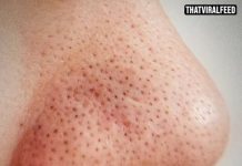 Dermatologist Warns Against Squeezing Black Spots On Your Nose Because They’re Not What You Think