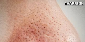 Dermatologist Warns Against Squeezing Black Spots On Your Nose Because They’re Not What You Think