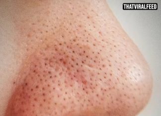 Dermatologist Warns Against Squeezing Black Spots On Your Nose Because They’re Not What You Think