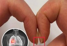 FINGER TEST FOR LUNG CANCER: A SIMPLE WAY TO DETECT HIDDEN RISK EARLY
