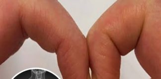 FINGER TEST FOR LUNG CANCER: A SIMPLE WAY TO DETECT HIDDEN RISK EARLY