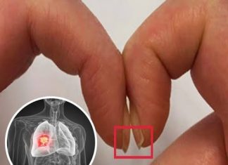 FINGER TEST FOR LUNG CANCER: A SIMPLE WAY TO DETECT HIDDEN RISK EARLY