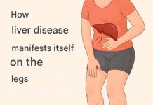 Your legs are screaming “HELP!”: 5 warning signs from your liver…..